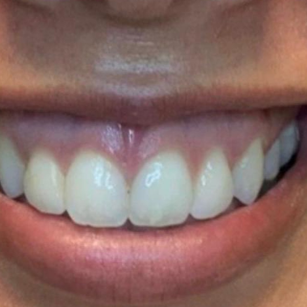Before treatment